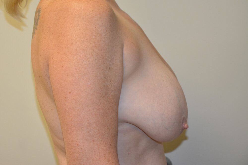 Breast-Reduction-22 | Before Breast Reduction 5