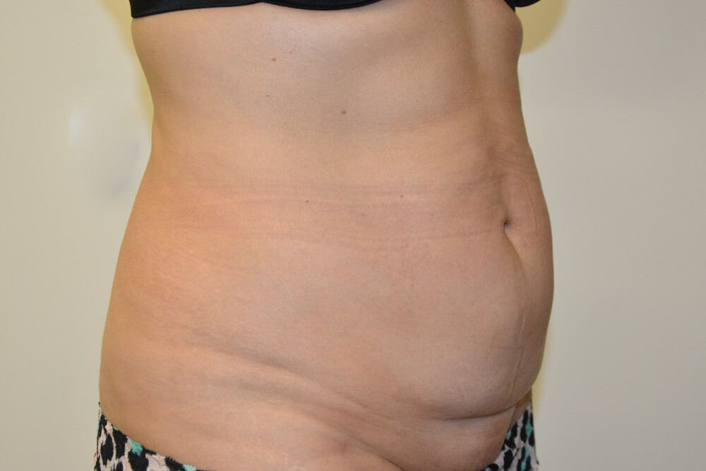 Tummy-Tuck-22 | Before Tummy Tuck 4