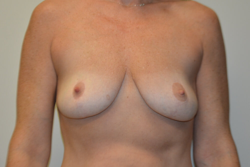 Breast-Reduction-22 | After Breast Reduction