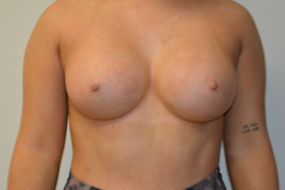 Breast-Augmentation-22 | After Breast Augmentation