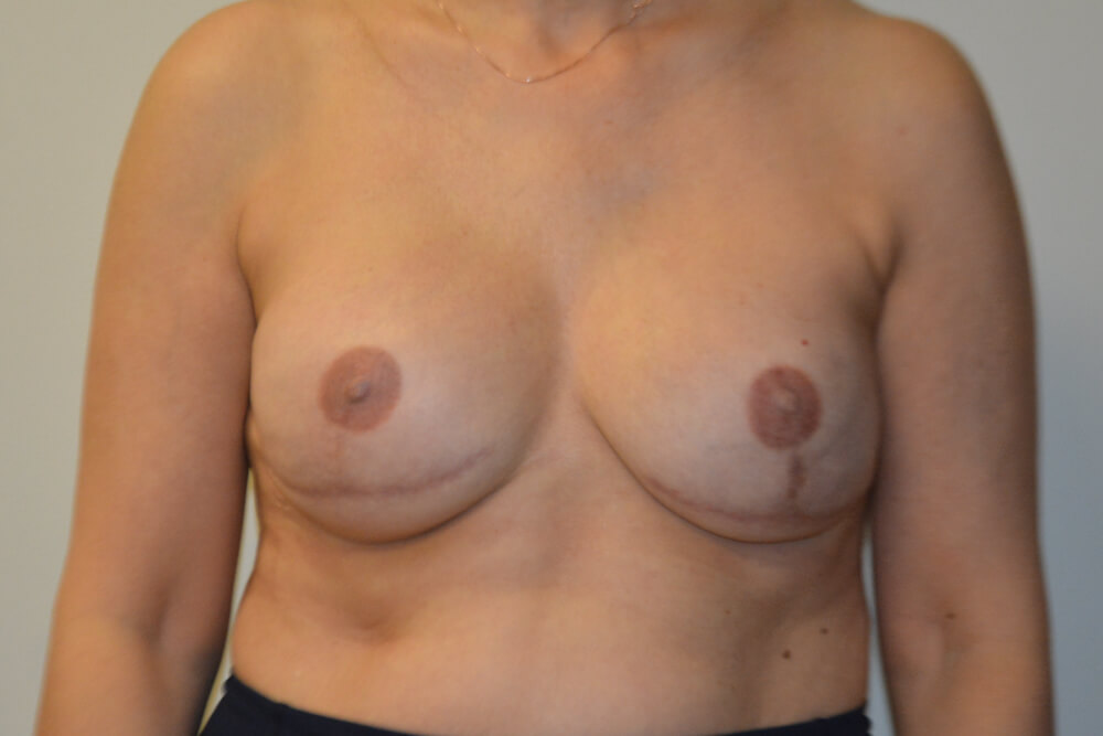 Breast-Reconstruction-Tissue-Expanders-22 | After Breast Reconstruction Tissue Expanders