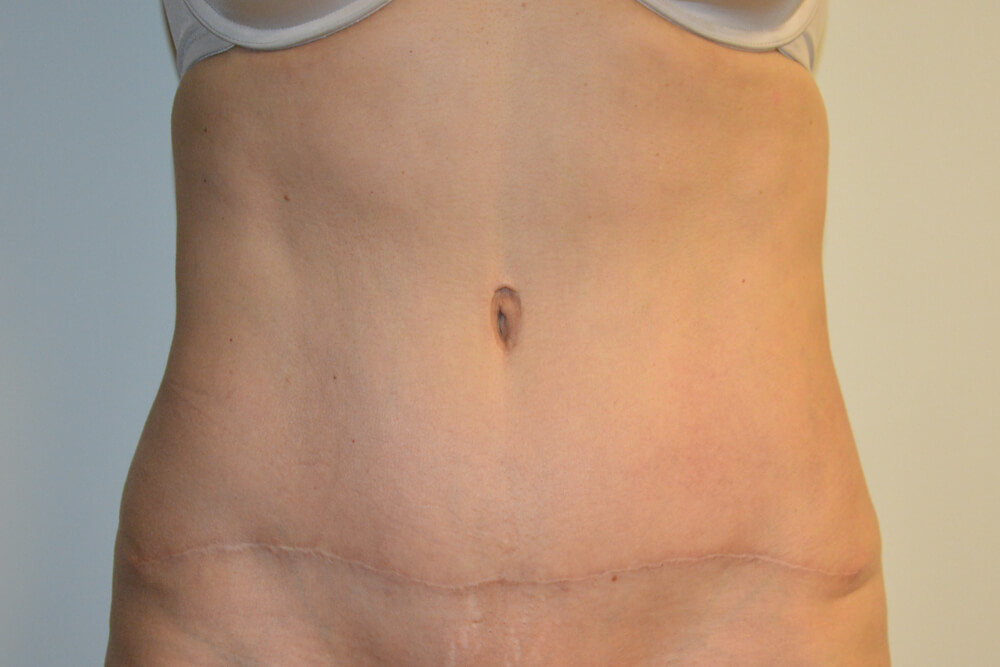 Tummy-Tuck-22 | After Tummy Tuck
