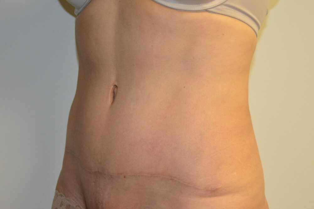 Tummy-Tuck-22 | After Tummy Tuck 2