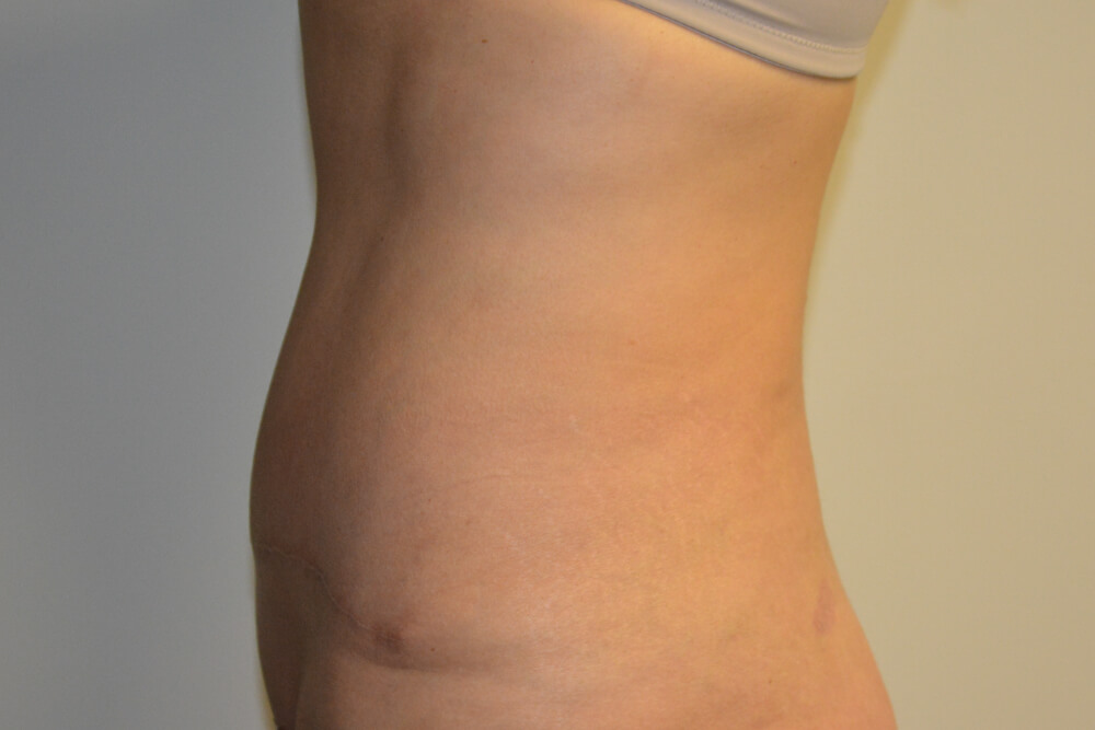 Tummy-Tuck-22 | After Tummy Tuck 3