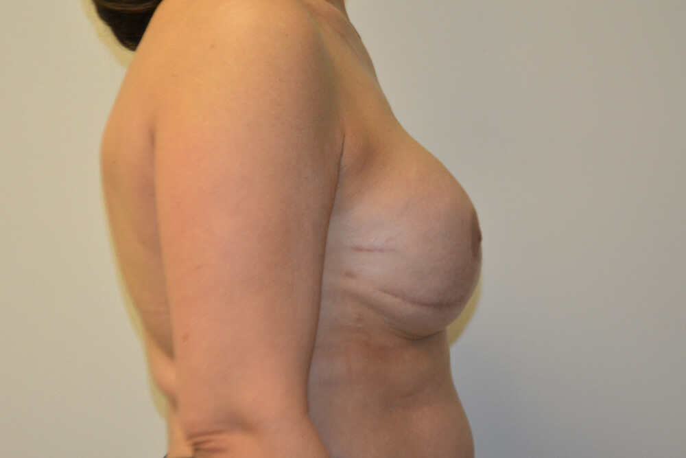 Breast-Reconstruction-Tissue-Expanders-22 | After Breast Reconstruction Tissue Expanders 3