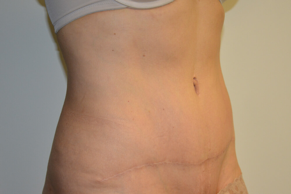 Tummy-Tuck-22 | After Tummy Tuck 4
