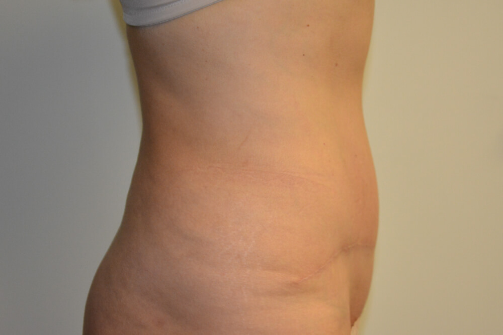 Tummy-Tuck-22 | After Tummy Tuck 5