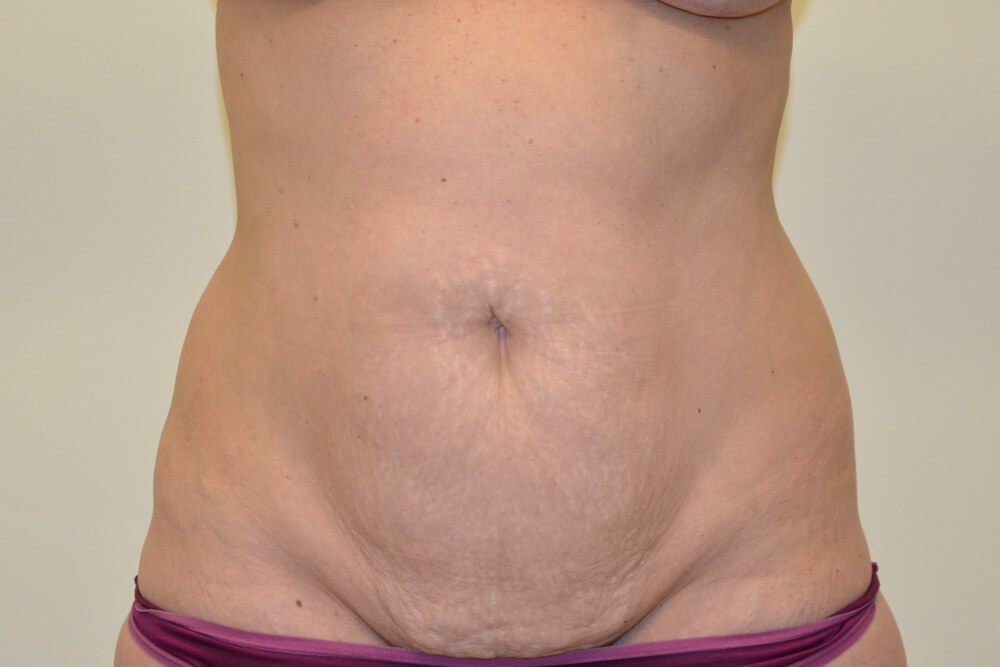 Tummy-Tuck-23 | Before Tummy Tuck
