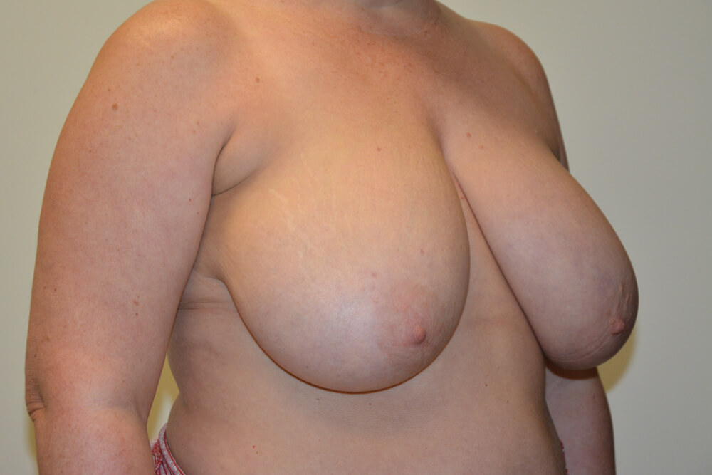 Breast-Reduction-23 | Before Breast Reduction 4