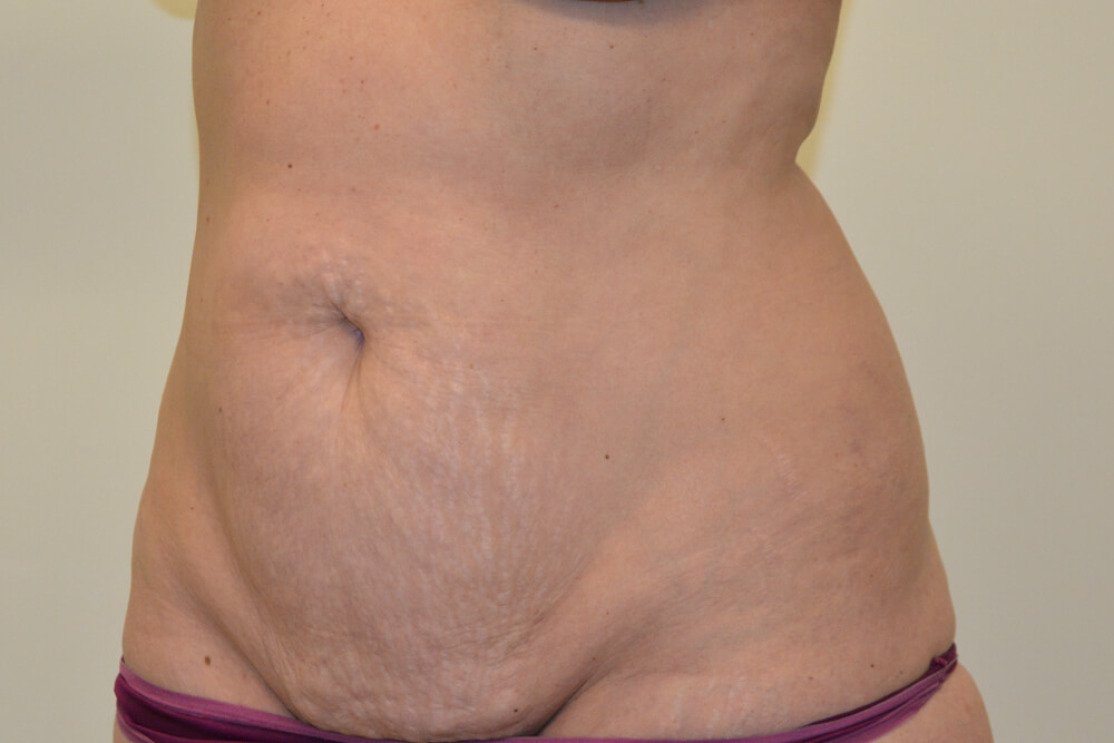 Tummy-Tuck-23 | Before Tummy Tuck 4