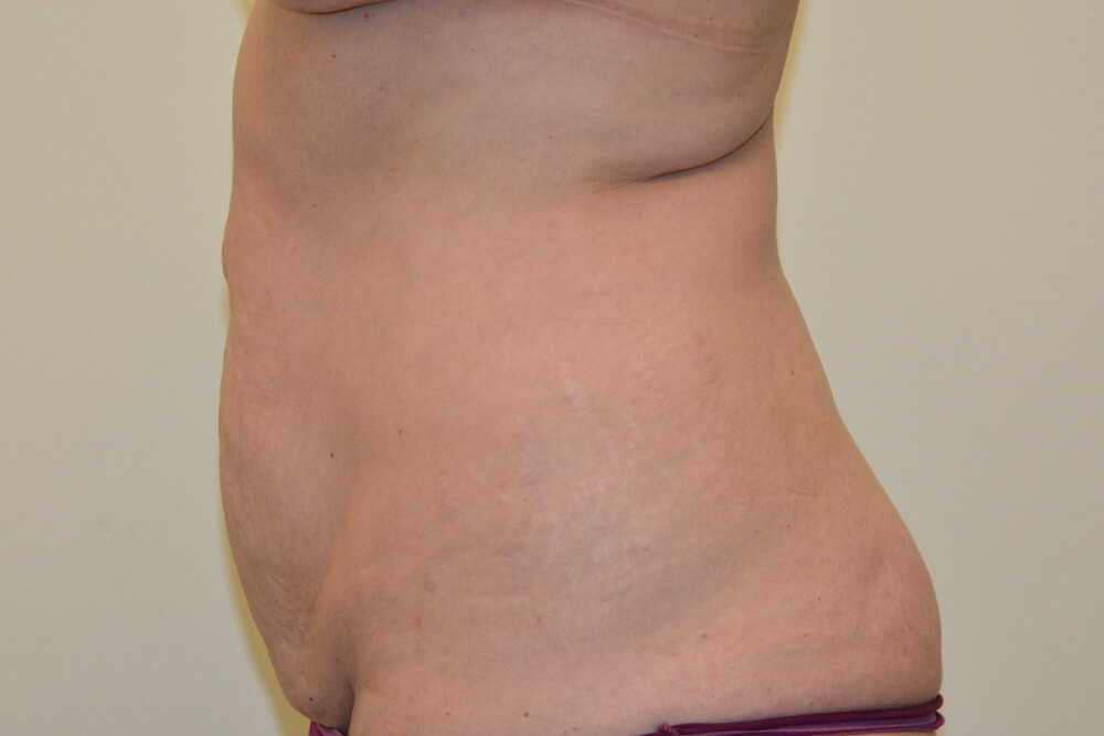 Tummy-Tuck-23 | Before Tummy Tuck 5