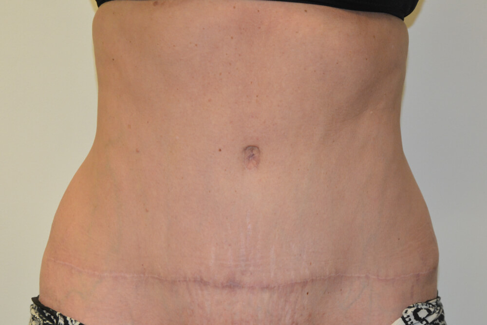 Tummy-Tuck-23 | After Tummy Tuck