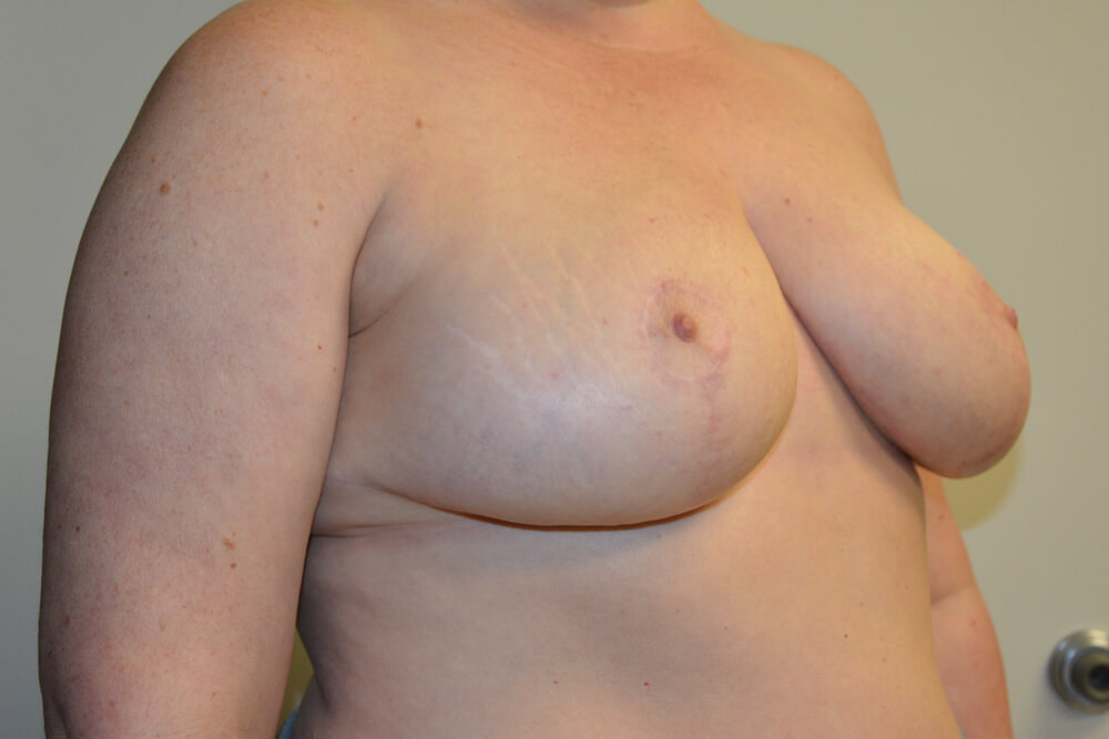 Breast-Reduction-23 | After Breast Reduction 4