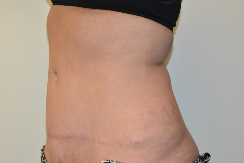 Tummy-Tuck-23 | After Tummy Tuck 4