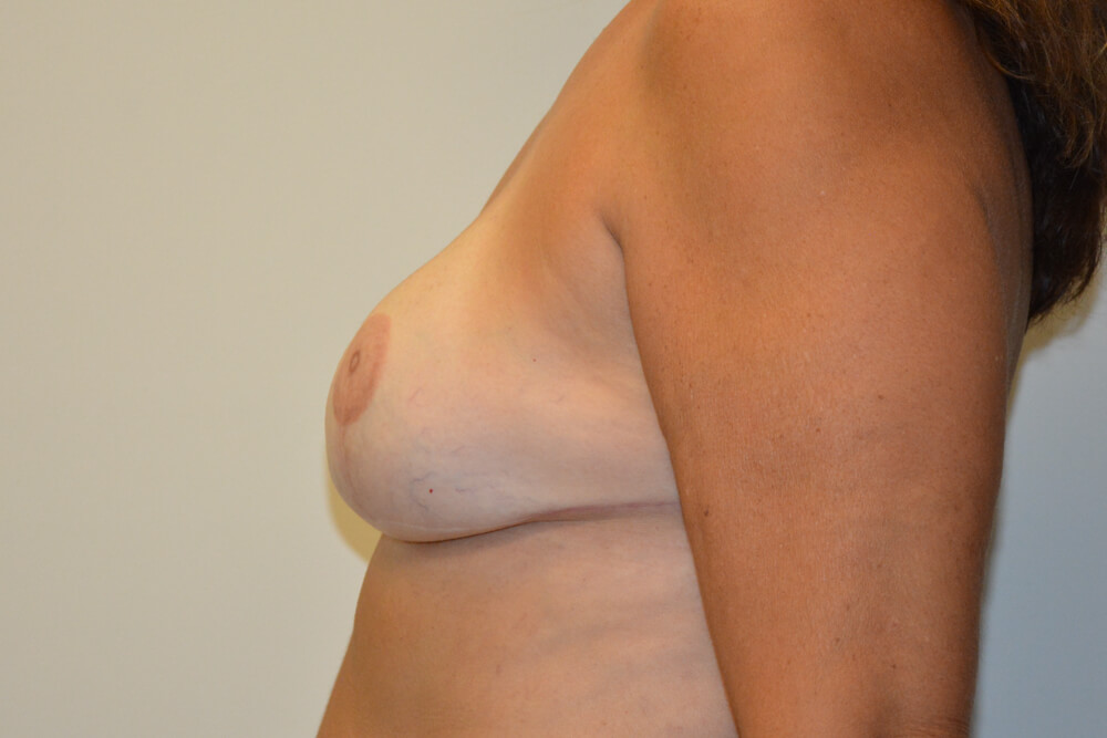 Breast-Reconstruction-Tissue-Expanders-23 | After Breast Reconstruction Tissue Expanders 3