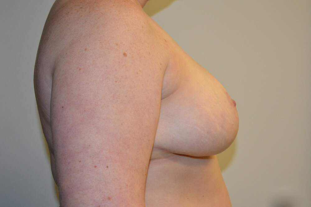 Breast-Reduction-23 | After Breast Reduction 5