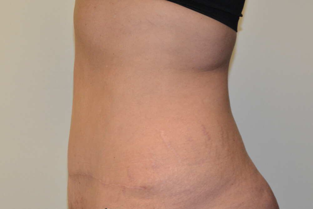 Tummy-Tuck-23 | After Tummy Tuck 5