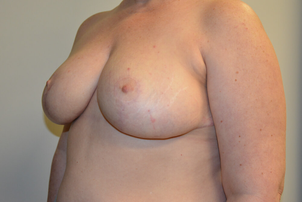 Breast-Reduction-23 | After Breast Reduction 2