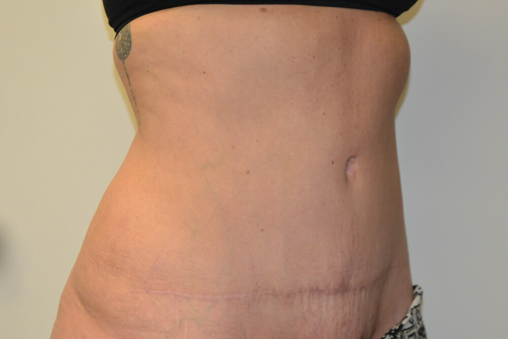 Tummy-Tuck-23 | After Tummy Tuck 2