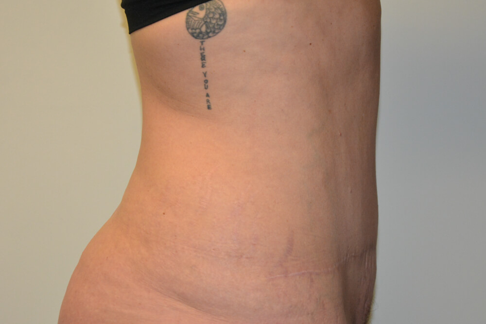 Tummy-Tuck-23 | After Tummy Tuck 3