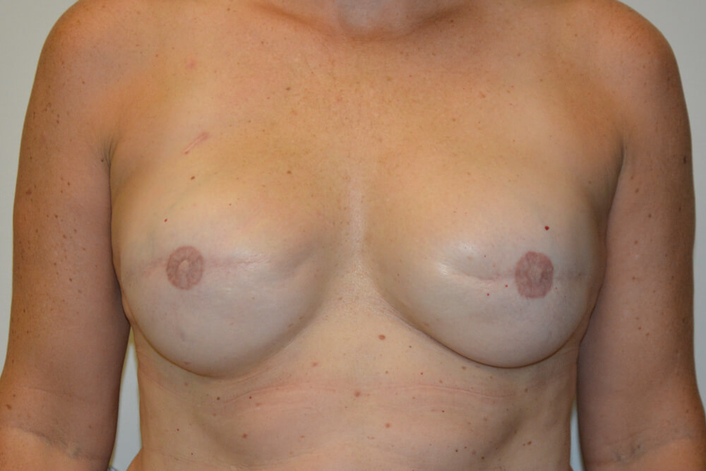 Breast-Reconstruction-Tissue-Expanders-24 | After Breast Reconstruction Tissue Expanders