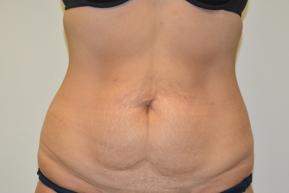 Tummy-Tuck-24 | Before Tummy Tuck