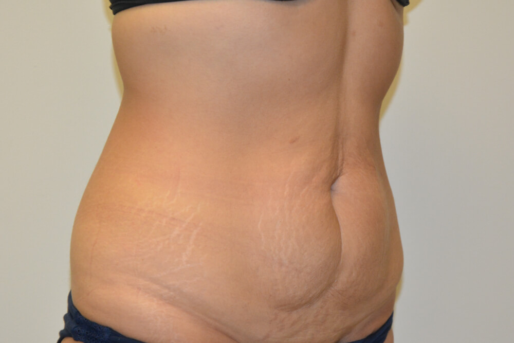 Tummy-Tuck-24 | Before Tummy Tuck 2