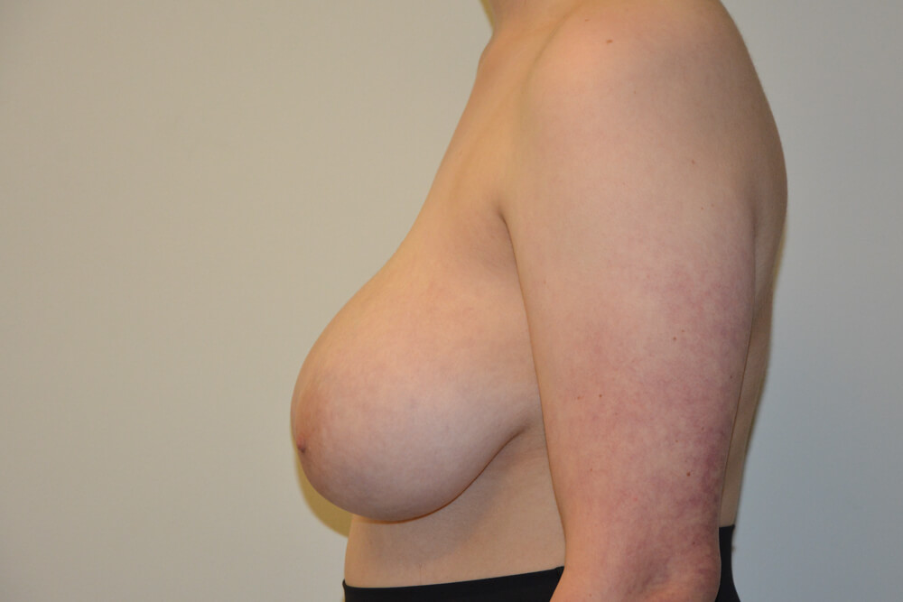 Breast-Reduction-24 | Before Breast Reduction 3