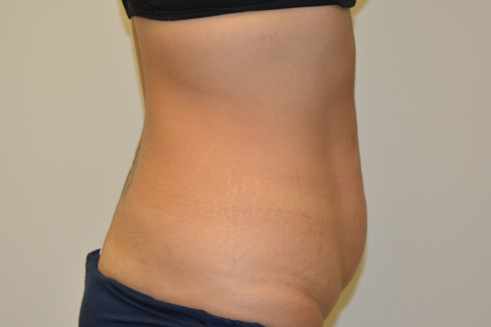Tummy-Tuck-24 | Before Tummy Tuck 3