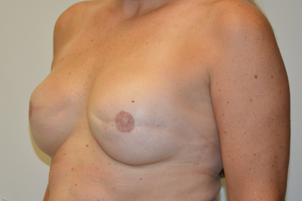 Breast-Reconstruction-Tissue-Expanders-24 | After Breast Reconstruction Tissue Expanders 2