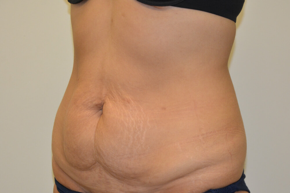 Tummy-Tuck-24 | Before Tummy Tuck 4