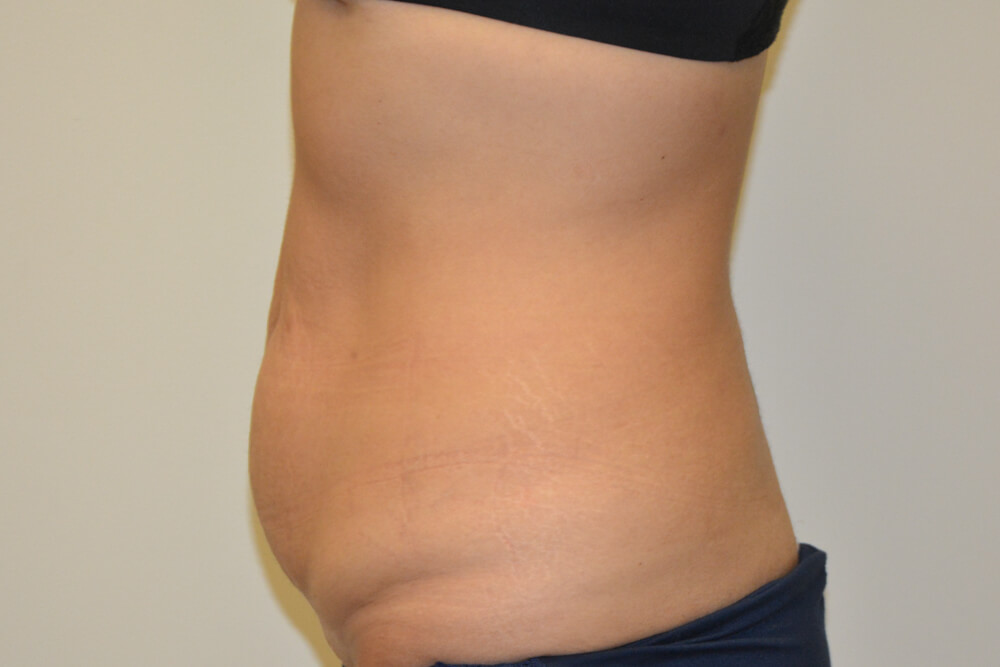Tummy-Tuck-24 | Before Tummy Tuck 5