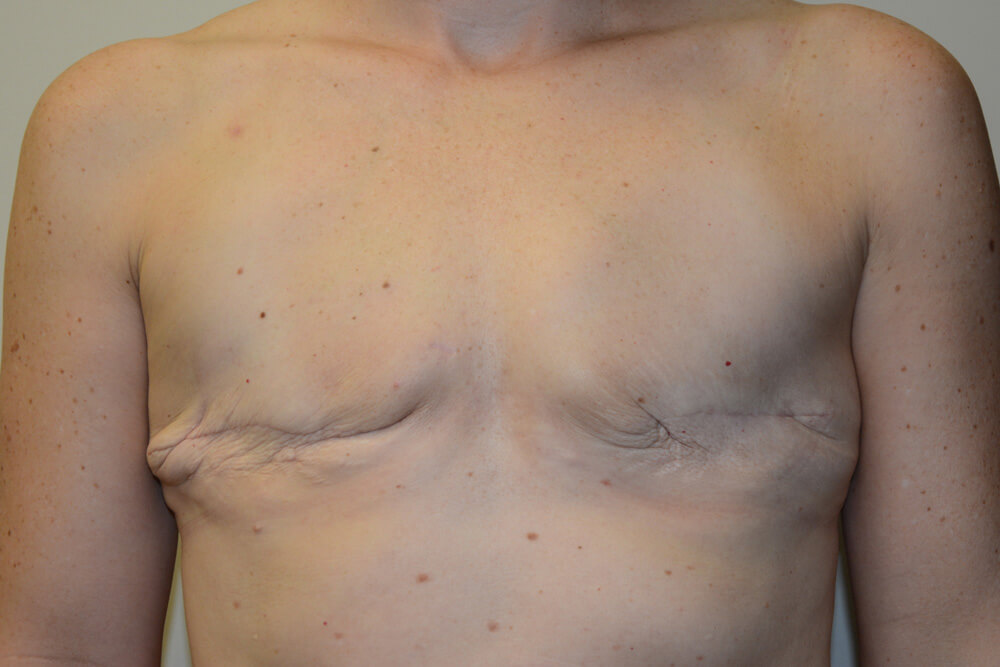 Breast-Reconstruction-Tissue-Expanders-24 | Before Breast Reconstruction Tissue Expanders