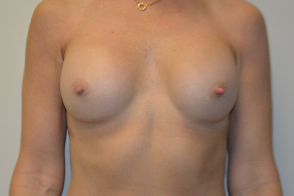 Breast-Revision-24 | After Breast Revision