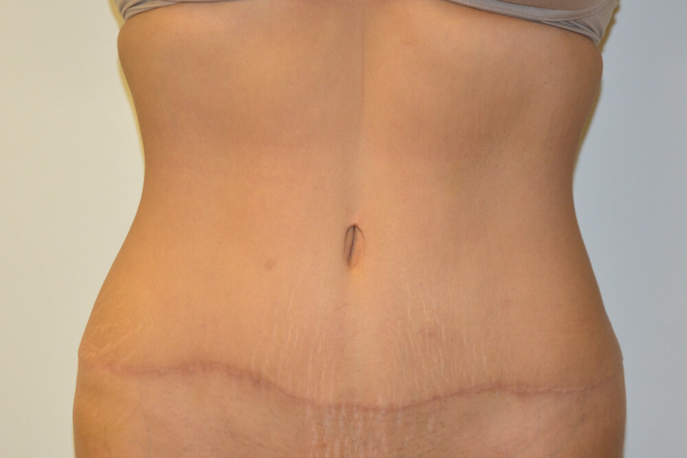 Tummy-Tuck-24 | After Tummy Tuck
