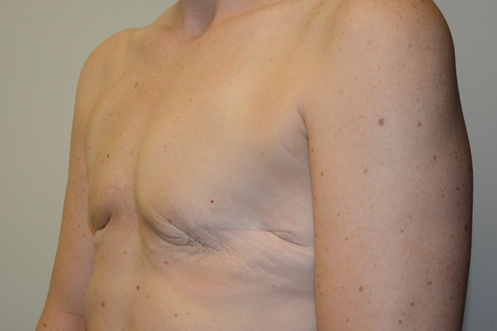 Breast-Reconstruction-Tissue-Expanders-24 | Before Breast Reconstruction Tissue Expanders 2