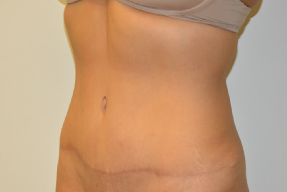 Tummy-Tuck-24 | After Tummy Tuck 4