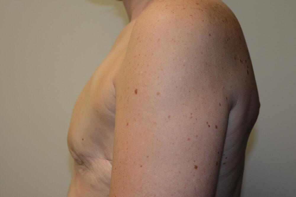 Breast-Reconstruction-Tissue-Expanders-24 | Before Breast Reconstruction Tissue Expanders 3