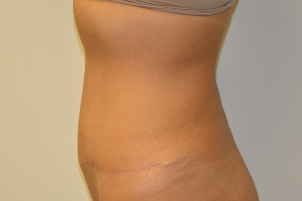 Tummy-Tuck-24 | After Tummy Tuck 5