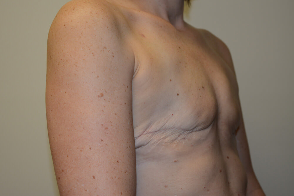 Breast-Reconstruction-Tissue-Expanders-24 | Before Breast Reconstruction Tissue Expanders 4