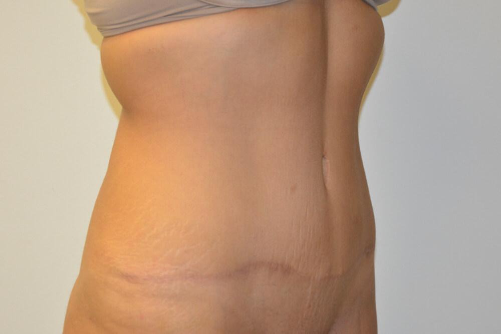Tummy-Tuck-24 | After Tummy Tuck 2