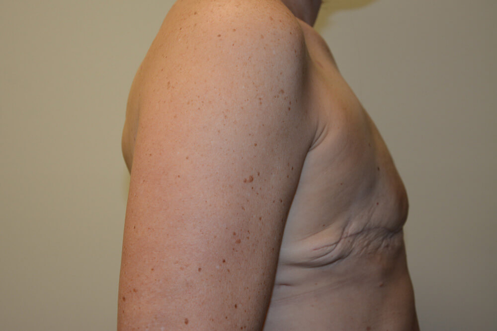 Breast-Reconstruction-Tissue-Expanders-24 | Before Breast Reconstruction Tissue Expanders 5