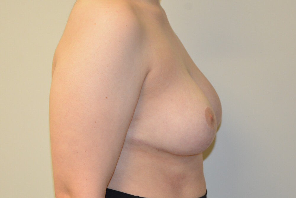 Breast-Reduction-24 | After Breast Reduction 5