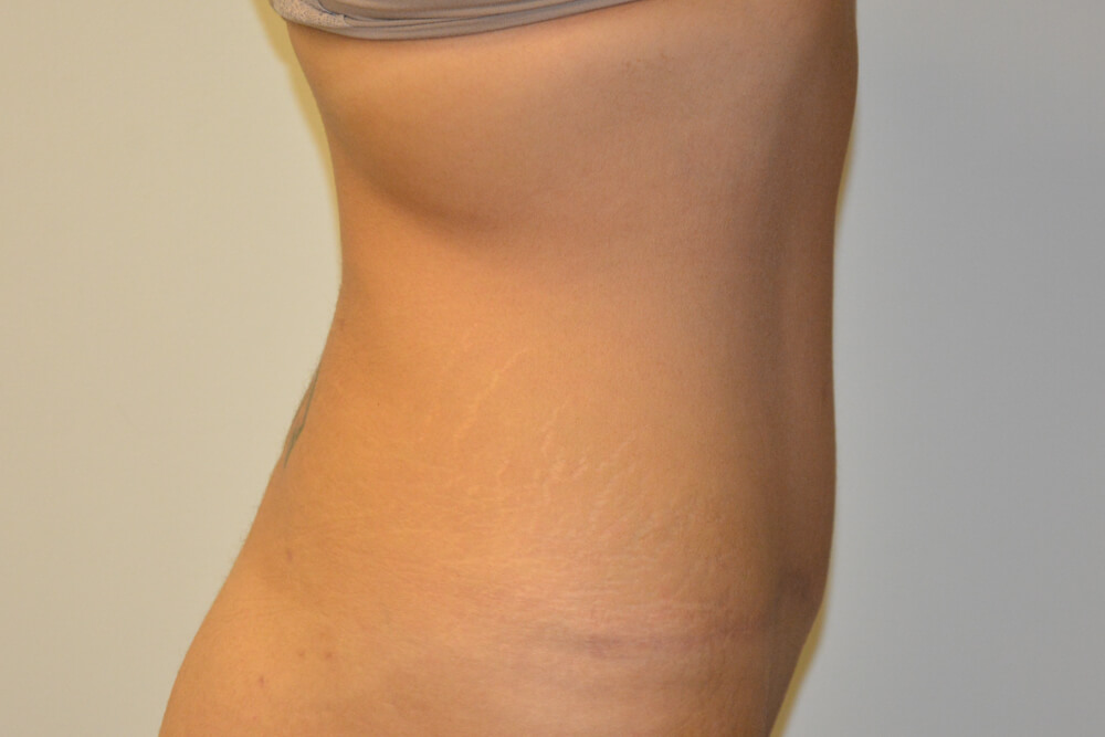Tummy-Tuck-24 | After Tummy Tuck 3