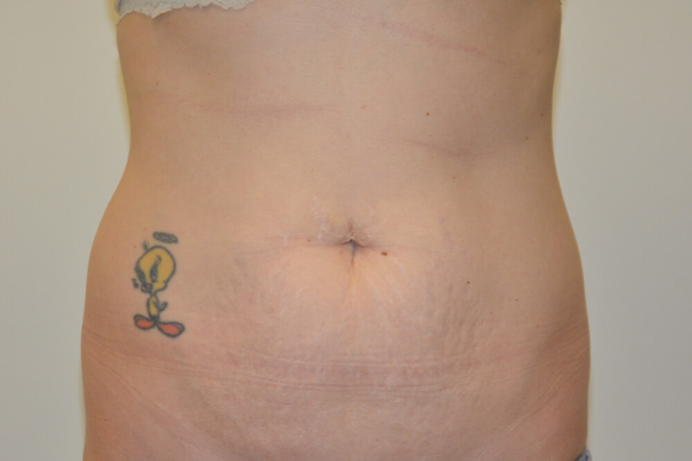 Tummy-Tuck-25 | Before Tummy Tuck