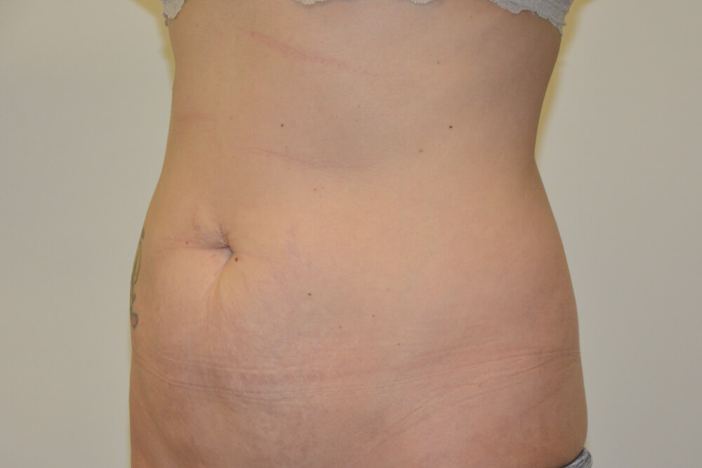 Tummy-Tuck-25 | Before Tummy Tuck 2