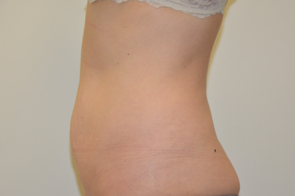 Tummy-Tuck-25 | Before Tummy Tuck 3