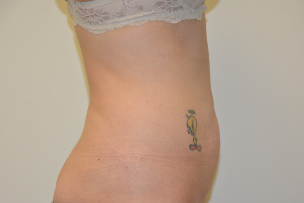 Tummy-Tuck-25 | Before Tummy Tuck 4