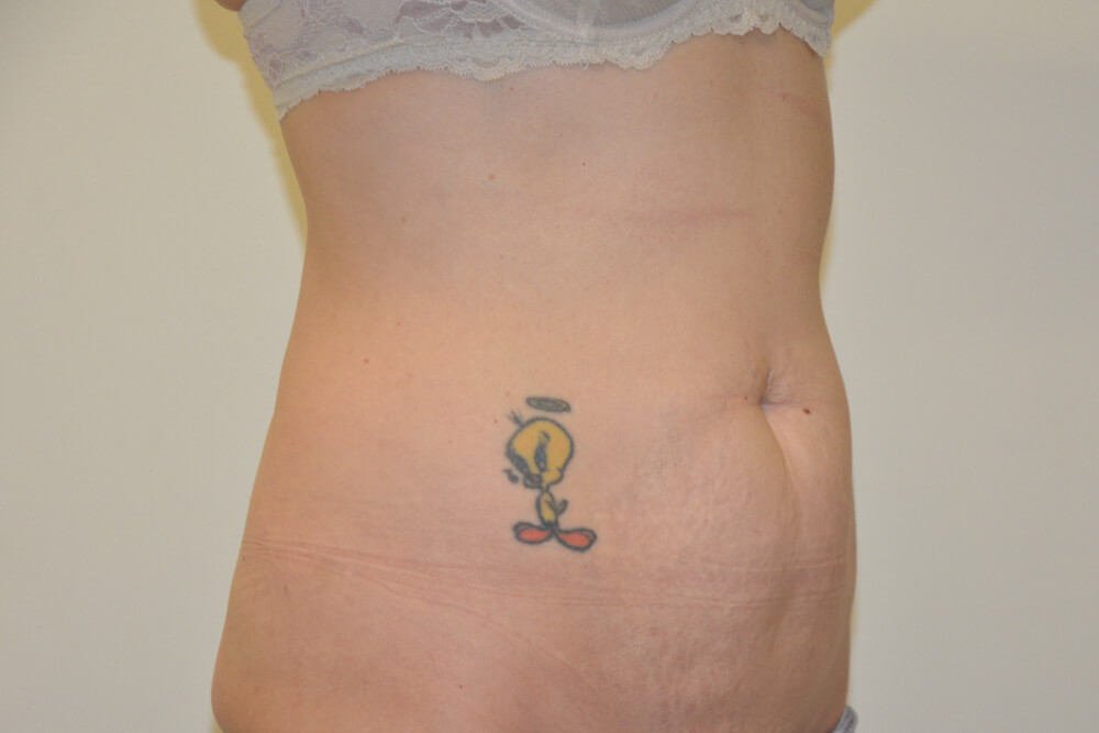 Tummy-Tuck-25 | Before Tummy Tuck 5