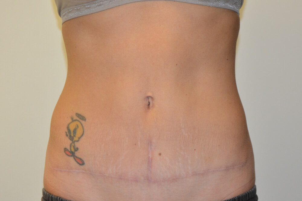 Tummy-Tuck-25 | After Tummy Tuck